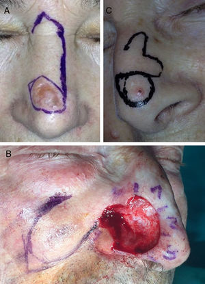 A) Colgajo pannasal para dorso de nariz. B) Colgajo nasolabial para reconstruir ala nasal. C) Colgajo bilobulado para punta nasal. Imagen A cedida por el Dr. Ricardo Ruiz Villaverde.