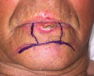 Colgajo doble de avance de Turgut en bermellón de labio inferior. Imagen cedida por la Dra. Dolores Sánchez Aguilar