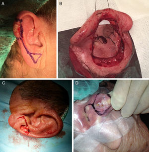 A) El colgajo de avance de hélix es el colgajo de elección en esta subunidad. B) Colgajo en puerta giratoria para defectos de la concha auricular. C) Colgajo de Limberg para lóbulo auricular. D) Colgajo de Limberg para zona retroauricular. Imagen A cedida por el Dr. Alfonso Rodríguez Bujaldón.