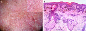 Polarized light dermoscopic examination displays whitish scales and numerous follicular keratotic plugs over a reddish-brown background; moreover, several perifollicular and interfollicular gray-blue granules (peppering) are also evident in the box (a). Histology reveals findings consistent with a diagnosis of erythromelanosis follicularis faciei et colli, i.e. slight orthokeratosis, follicular hyperkeratosis, increased basal layer pigmentation, perivascular and periadnexal lymphocytic infiltrate, and pigmentary incontinence with dermal melanophages (hematoxylin and eosin stain 200×) (b).