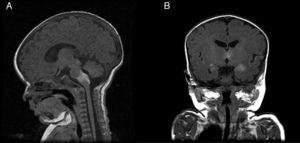 A. Resonancia magnética cerebral, corte sagital: imagen hiperintensa en T1 al nivel del bulbo y la unión bulbo-protuberancial. B. Resonancia magnética cerebral, corte coronal: imágenes hiperintensas en T1 al nivel del tálamo y los lóbulos temporales.