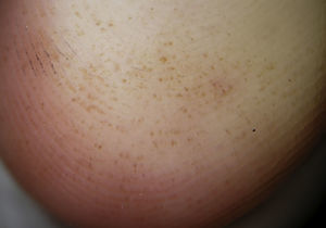 Múltiples puntos marrón-rojizos irregulares (pebbles). Los puntos se distribuían por la cresta de los dermatoglifos principalmente.