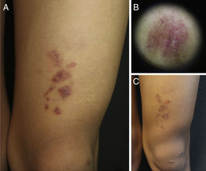 Imágenes clínico-dermatoscópicas del paciente. A) Placas eritemato-purpúricas brillantes con fina descamación superficial agrupadas en la rodilla izquierda. B) Dermatoscopia con puntos rojos sobre fondo marrón-gris con retícula fina. C) Evolución de la lesión tras varios intentos de tratamientos. Nótese leve disminución del tono, pero persistencia de las placas.