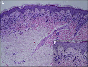 Histología de la lesión. A) Infiltrado inflamatorio liquenoide en banda en dermis papilar respetando estructuras anexiales (H&E ×10). B) Extravasación hemática extensa (H&E ×40).
