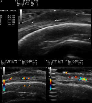 A. Nódulo hipoecoico de bordes bien definidos donde los bordes son de una ecogenicidad ligeramente superior al centro. B. El doppler color mostraba un aumento de la vascularización y vasos de mediano calibre asimétricamente distribuidos en la base del nódulo. C. Aumento de la vascularización en la zona no nodular de la lesión.