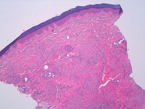 Hematoxilina-eosina ×10. Degeneración focal del colágeno y fibras elásticas, depósitos de mucina e infiltrado linfohistiocítico perivascular e intersticial en la dermis superior y media.