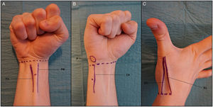Bloqueo de los nervios periféricos al nivel de la muñeca. A. Bloqueo del nervio mediano. PM: Tendón del músculo palmar mayor o flexor radial del carpo; Pm: tendón del músculo palmar menor o palmar largo. B. Bloqueo del nervio cubital. CA: tendón del músculo cubital anterior o flexor cubital del carpo; P: hueso pisiforme. C. Bloqueo del nervio radial. EC: tendón del músculo extensor corto del pulgar; EL: tendón del músculo extensor largo del pulgar.