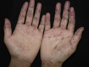 Several erosions on the palms of the hands, often recalcitrant.