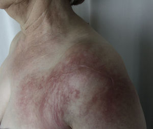 Primer caso: placa eritematoedematosa de aspecto livedoide, de límites mal delimitados, que ocupaba toda la región del hombro hasta el tercio proximal del deltoides.