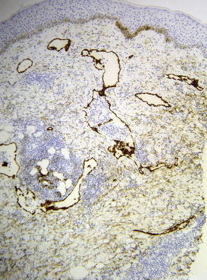 Biopsia cutánea: las células de las paredes de los vasos son positivas a D2-40 (marcador específico para los vasos linfáticos, ×100).