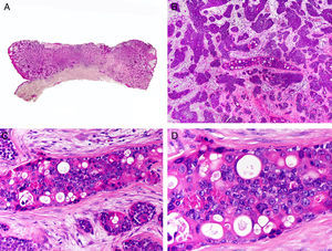 Características histopatológicas del porocarcinoma. A. Visión panorámica mostrando una neoplasia ulcerada que infiltra todo el espesor de la dermis. B. Agregados neoplásicos de forma y tamaño variable. C. Algunos agregados neoplásicos muestran diferenciación ductal. D. Detalle de los pequeños ductos tapizados por células cuticulares. (Hematoxilina-eosina, A ×10, B ×40, C ×200, D ×400).