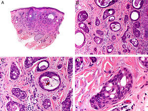 Características histopatológicas del carcinoma anexial microquístico. A. Visión panorámica mostrando una neoplasia que infiltra todo el espesor de la dermis. B. Agregados sólidos y pequeños quistes conteniendo queratina. C. Algunos agregados tumorales muestran formaciones ductales diminutas. D. Detalle de las pequeñas formaciones ductales en algunos de los agregados neoplásicos. (Hematoxilina-eosina, A ×10, B ×40, C ×200, D ×400).