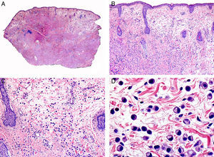 Características histopatológicas del carcinoma de células en anillo de sello de párpado. A. Visión panorámica mostrando una neoplasia mal delimitada que infiltra todo el espesor de la dermis. B. La neoplasia está constituida por células aisladas salpicadas por la dermis. C. En algunas áreas el estroma de la neoplasia es mixoide. D. Detalle a gran aumento de las células neoplásicas con morfología en anillo de sello. (Hematoxilina-eosina, A ×10, B ×40, C ×200, D ×400).