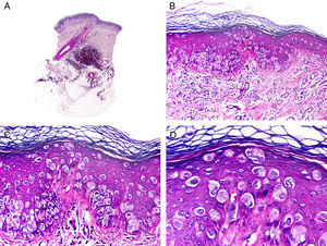 Características histopatológicas de la enfermedad de Paget extramamaria. A. Visión panorámica mostrando una lesión intraepidérmica. B. La neoplasia está constituida por células neoplásicas aisladas salpicando la epidermis. C. Estas células neoplásicas muestran un núcleo pleomórfico y abundante citoplasma pálido. D. Detalle de las células neoplásicas salpicando la epidermis. (Hematoxilina-eosina, A ×10, B ×40, C ×200, D ×400).