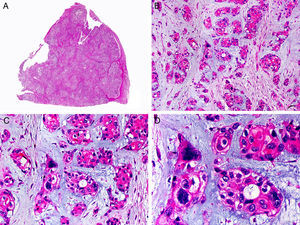 Características histopatológicas del tumor mixto maligno. A. Visión panorámica mostrando una neoplasia mal delimitada. B. Agregados de células epiteliales neoplásicas inmersas en un estroma mixoide. C. Los agregados neoplásicos están constituidos por células de núcleo atípico y pleomórfico. D. Alguno de los agregados neoplásicos muestra evidencia de diferenciación ductal. (Hematoxilina-eosina, A ×10, B ×40, C ×200, D ×400).