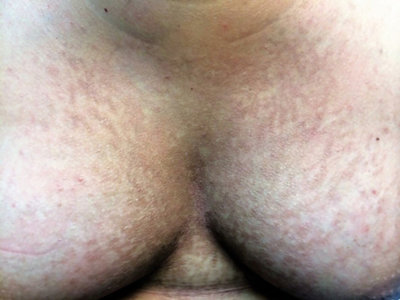 Papilomatosis confluente y reticulada con pseudoestrías lineales ...