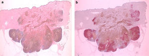 Panoramic view of the lesion (a; HE ×10) and with red chromogen and HMB45 (b; HE ×10).