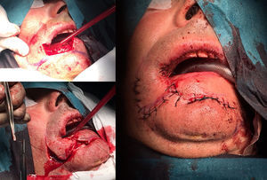 Secuencia de imágenes del acto quirúrgico.