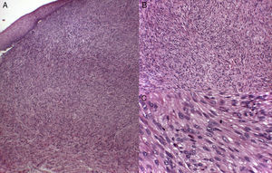 Infiltración difusa y mal delimitada de fascículos entrelazados de fibras musculares lisas, compuestas por células fusiformes, de núcleo alargado y extremos romos («en forma de cigarro puro») con marcado pleomorfismo y un citoplasma eosinófilo. (Tinción de hematoxilina-eosina: A. X10 B. X20C. X40).