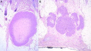 Comparativa histopatológica de leiomiosarcoma hipodérmico primario A) y metástasis cutánea secundaria de leiomiosarcoma B).