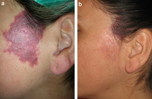 a) Malformación capilar violácea sin hipertrofia asociada. b) Mejoría marcada tras 3 sesiones de tratamiento.