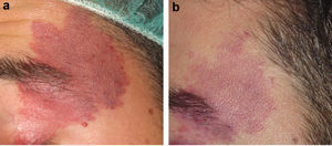 a) Malformación capilar de coloración roja sin hipertrofia asociada. b) Aclaramiento parcial tras 4 sesiones de tratamiento.