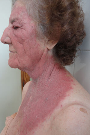 Caso 1. Eritema y descamación a nivel del rostro y zona del escote respetando zona retroauricular y fondo de pliegue cervical.