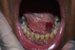 Lesiones en la base de la lengua, friables y con erosión.