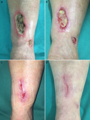 a) Úlceras cutáneas de fondo necrótico afectando a miembros inferiores. b-d) Cicatrización progresiva de las úlceras tras instauración de rivaroxabán oral.
