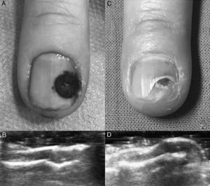 A) Resultado clínico inmediato tras cirugía. B) Comprobación ecográfica inmediata de resolución del tumor. C) Resultado clínico a las 2 semanas de la cirugía. D) Comprobación ecográfica a las 2 semanas de extirpación del tumor.