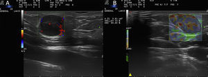 A) Ecografía en modo Doppler color donde se objetiva una lesión hipoecoica a nivel hipodérmico con hipervascularización intralesional. B) Elastografía de strain mostrando una significativa rigidez media.