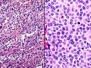 A) Imagen histopatológica donde se objetivan abundantes macrófagos, polimorfonucleares y restos de queratina compatibles con un quiste de retención (H&E ×40). B) Imagen histopatológica donde se observa una proliferación melanocítica con abundantes figuras de mitosis en relación con metástasis de melanoma (H&E ×100).