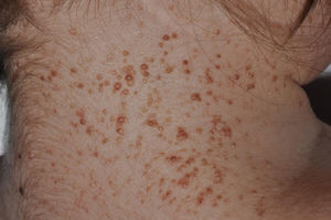 Múltiples carcinomas basocelulares en paciente con síndrome de Gorlin. Cortesía de la Dra. Á. Hernández Martín.