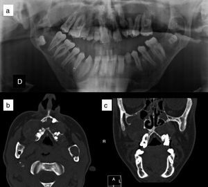 Queratoquistes odontogénicos en paciente con síndrome de Gorlin. a) Ortopantomografía, donde se aprecian queratoquistes engoblando varios molares. b) Corte axial de tomografía computerizada en el que se observan queratoquistes odontogénicos maxilares. c) Corte coronal de tomografía computerizada, donde se visualizan queratoquistes maxilares que comprimen los senos paranasales. Cortesía de la Dra. E. García Esparza.