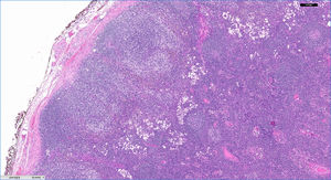 Paciente 4 (HE×5): ganglio linfático con conservación de la arquitectura que presenta hiperplasia de folículos linfoides en la cortical con aclaramiento paracortical.