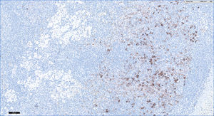 Paciente 4 (CD1A×10): en paracórtex se observa hiperplasia de células de Lagherhans.