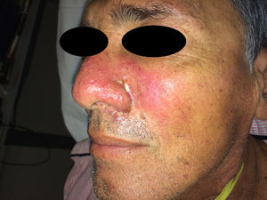 Placa eritematosa, dura, elástica, de límites difusos, localizada en el dorso nasal y la región malar izquierda, sobre la cual asienta una úlcera redondeada, de 5mm de diámetro con fondo 100% fibrinoso.
