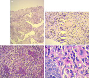 a) Hematoxilina y eosina 10×: presencia de histiocitos y células gigantes multinucleadas de tipo Langhans en la dermis. b) Hematoxilina y eosina 40×: célula gigante multinucleada de Langhans. c) Coloración de PAS 40×: presencia de múltiples células gigantes multinucleadas. d) Coloración de PAS 100×: levaduras intrahistiocitarias.