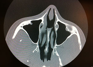 TAC: se observa perforación del septo nasal sin otras alteraciones.