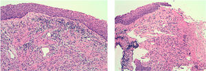 Biopsia del septo nasal (tinción hematoxilina eosina, amplificación original ×10).