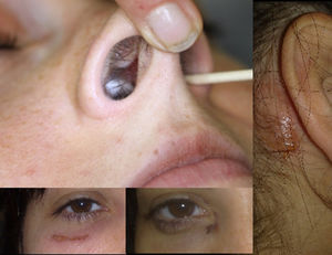 Perforación del septo nasal y lesiones escoriadas en ojo derecho y zona retroauricular derecha.