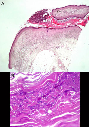 A) Trayecto sinusal relleno por material hiperqueratósico, con una pústula en superficie (H&E ×20). B) Tinción de PAS: estructuras micóticas en forma de esporas e hifas ramificadas, en ángulos de 45°.