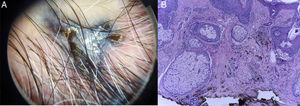 A) Dermatoscopia con patrón azul homogéneo, con estrías blancas brillantes. B) Fibrosis y proliferación de células névicas con marcada pigmentación melánica intracitoplasmática y melanófagos en dermis, sin signos de malignidad.