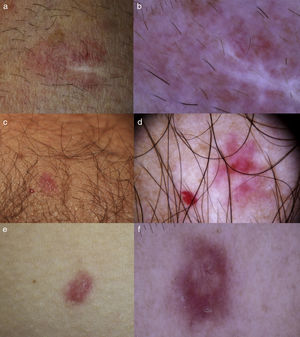 a) Caso 1: HMV en antebrazo derecho en un varón de 67 años. b) Se observa únicamente un área rosada homogénea y telangiectasias finas arboriformes. La zona blanquecina corresponde a la cicatriz de la biopsia. c) Caso 2: HMV (derecha) adyacente a un punto rubí (izquierda) en el antebrazo de un varón de 70 años. d) Imagen dermatoscópica del HMV donde se ve área rojiza homogénea central y telangiectasias finas parcheadas. e) Caso 3: HMV en el costado derecho de una mujer de 32 años. f) En la dermatoscopía se observa un área central de color rosado blanquecino con telangiectasias ramificadas y un seudoquiste de milio en su interior y rodeada por una zona eritematosa con telangiectasias reticulares en la periferia.
