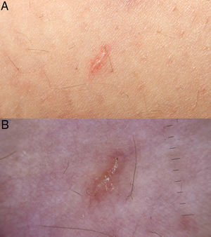 Ejemplos de fotografías realizadas con el EF-M 28mm f/3,5 Macro IS STM. A)Fotografía macro a una distancia focal corta. B)Imagen de dermatoscopia correctamente centrada, sin el halo oscuro periférico y sin pérdida de campo de visión.