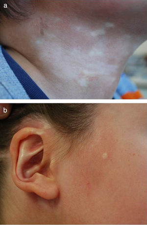 Paciente varón de 5 años con morfea mixta, circunscrita-lineal (MCDS) (clasificación de la PReS). Se muestra el componente de morfea circunscrita, con placas localizadas en a) lateral derecho del cuello y b) regiones preauricular y parotídea derechas, incluyendo afectación del pabellón auricular.