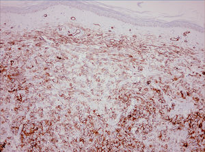Inmunohistoquímica, tinción CD34 (×10).