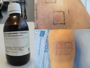A) Aceite de neem. B) Lectura de pruebas epicutáneas a las 96h para aceite de neem (+++). C) Lectura a las 96h de las diluciones al 25 y 50%.