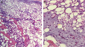 A y B) Lesión mesenquimal compuesta por adipocitos inmaduros (hematoxilina-eosina 10x) y células fusiformes (hematoxilina-eosina 40x).