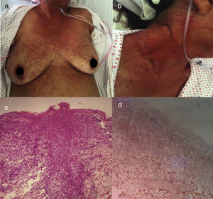 LLCTA aguda. (a) Mujer de 64 años de edad con múltiples pápulas distribuidas por tronco y extremidades proximales de 3 meses de evolución. (b) Las pápulas son asintomáticas, eritematosas y con una buena consistencia. (c) Infiltración de la dermis por células linfoides atípicas con epidermotropismo. Tinción con hematoxilina y eosina, ×20. (d) Inmunohistoquímica CD3+, ×20. La paciente falleció 2 semanas después del ingreso a causa de un shock séptico.